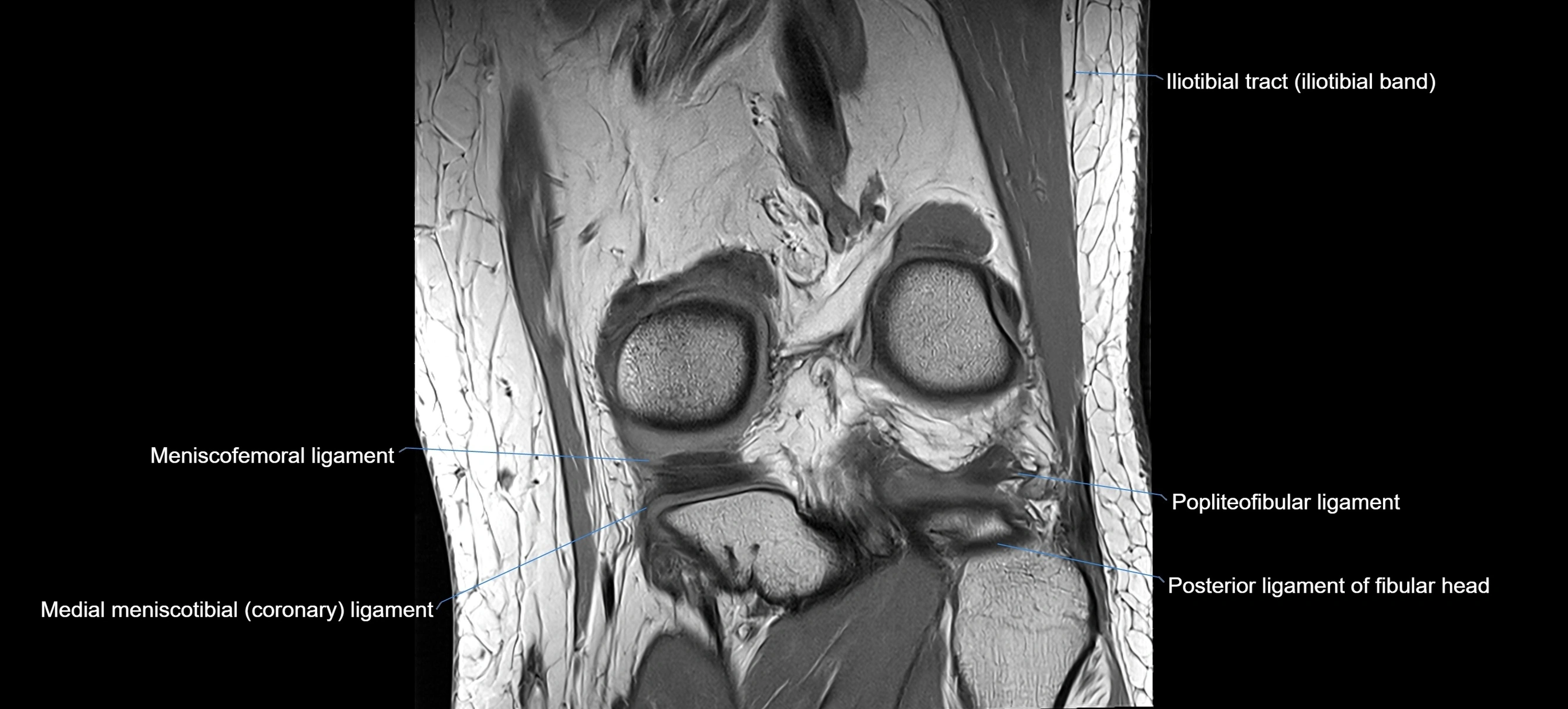 MRI coronal  ligaments cross sectional anatomy 3T  radiology  image-img-04001-00028.webp